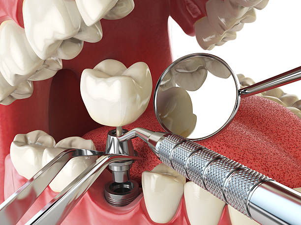 Best Emergency Tooth Extraction in Hackberry, TX